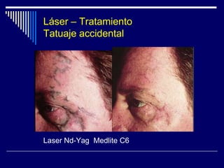 TIPOS DE LASERLaser ND - YAGSiglas: Neodimio: Itrio-Aluminio-Garnet.Cromóforo: agua intracelular y extracelular.Longitud de onda: 1064 nm. (infrarrojo) y 532 nm.Diferentes modos de emisión:Onda continua: Produce menor daño que el láser de CO2: Uso en cosmética para el rejuvenecimiento cutáneo.Pulso largo (vasculight): Lesiones vasculares. Mayor  longitud de onda que los de colorante pulsado, tiene mayor poder de penetración --  alcanza vasos de mayor calibre y más profundos.Q-Switched: Pigmentos profundos y tatuajes, depilación , Puede inducir oscurecimiento irreversible del pigmento en algunos tatuajes.