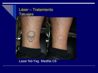 LASER - Aparatología