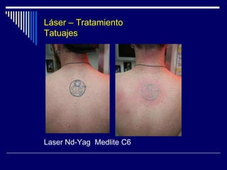 LASER - Aparatología						Laser Nd-Yag						Medlite C6					     1064 - 532 nm.					       585 - 650 nm.