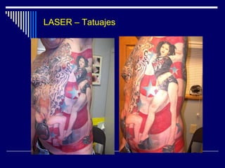 LASER - Aparatología						Laser Nd-Yag						Medlite C6					    1064 - 532 nm.					      585 - 650 nm.