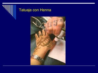 Láser – TratamientoOcronosisLaser Nd-Yag  Medlite C6