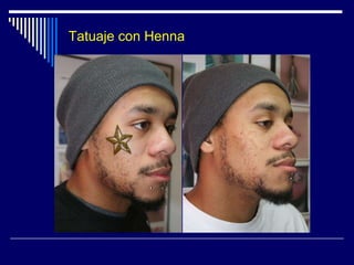 Láser – TratamientoEfélidesLaser Nd-Yag  Medlite C6