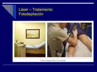Láser – TratamientoTatuaje accidentalLaser Nd-Yag  Medlite C6
