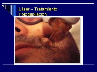 Láser – TratamientoTatuajesLaser Nd-Yag  Medlite C6