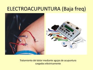 ELECTROACUPUNTURA (Baja freq)
Tratamiento del dolor mediante agujas de acupuntura
cargadas eléctricamente
 
