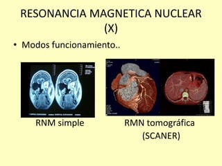 RESONANCIA MAGNETICA NUCLEAR
(X)
• Modos funcionamiento..
RNM simple RMN tomográfica
(SCANER)
 