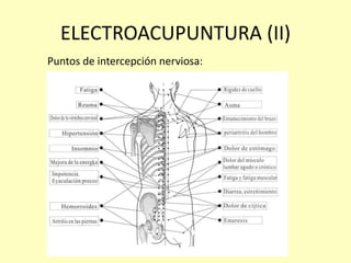ELECTROACUPUNTURA (II)
Puntos de intercepción nerviosa:
 