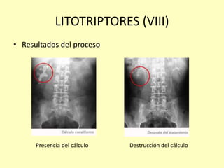 LITOTRIPTORES (VIII)
• Resultados del proceso
Presencia del cálculo Destrucción del cálculo
 