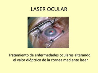 LASER OCULAR
Tratamiento de enfermedades oculares alterando
el valor dióptrico de la cornea mediante laser.
 