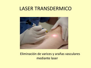 LASER TRANSDERMICO
Eliminación de varices y arañas vasculares
mediante laser
 