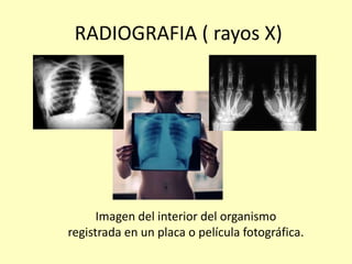 RADIOGRAFIA ( rayos X)
Imagen del interior del organismo
registrada en un placa o película fotográfica.
 
