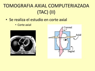 TOMOGRAFIA AXIAL COMPUTERIAZADA
(TAC) (II)
• Se realiza el estudio en corte axial
• Corte axial
 