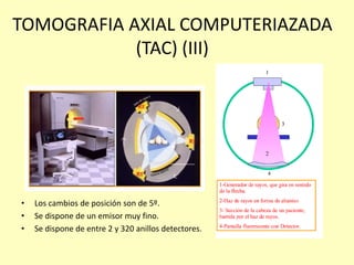 TOMOGRAFIA AXIAL COMPUTERIAZADA
(TAC) (III)
• Los cambios de posición son de 5º.
• Se dispone de un emisor muy fino.
• Se dispone de entre 2 y 320 anillos detectores.
 