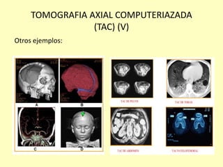 TOMOGRAFIA AXIAL COMPUTERIAZADA
(TAC) (V)
Otros ejemplos:
 