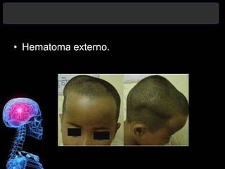 • Hematoma externo.
 