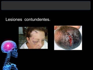 Lesiones contundentes.
 