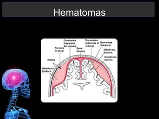 Hematomas
 