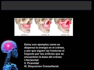 Estos son ejemplos como se
dispersa la energía en el cráneo,
y por que siguen las fracturas el
trayecto por los orificios que se
encuentran la base del cráneo
I.Horizontal
II. Piramidal
III. Disyuncion Craneofacial.
 
