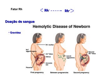 Fator Rh Doação de sangue Gravidez Rh - Rh + 