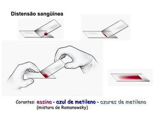 Distensão sangüínea Corantes:   eosina  –  azul de metileno  –  azures de metileno   (mistura de Romanowsky) 