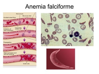 Anemia falciforme 