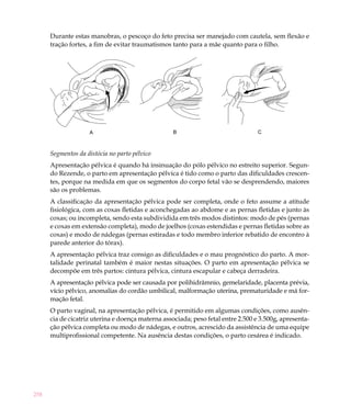 Durante estas manobras, o pescoço do feto precisa ser manejado com cautela, sem flexão e
      tração fortes, a fim de evitar traumatismos tanto para a mãe quanto para o filho.




                    A                              B                              C



      Segmentos da distócia no parto pélvico
      Apresentação pélvica é quando há insinuação do pólo pélvico no estreito superior. Segun-
      do Rezende, o parto em apresentação pélvica é tido como o parto das dificuldades crescen-
      tes, porque na medida em que os segmentos do corpo fetal vão se desprendendo, maiores
      são os problemas.
      A classificação da apresentação pélvica pode ser completa, onde o feto assume a atitude
      fisiológica, com as coxas fletidas e aconchegadas ao abdome e as pernas fletidas e junto às
      coxas; ou incompleta, sendo esta subdividida em três modos distintos: modo de pés (pernas
      e coxas em extensão completa), modo de joelhos (coxas estendidas e pernas fletidas sobre as
      coxas) e modo de nádegas (pernas estiradas e todo membro inferior rebatido de encontro à
      parede anterior do tórax).
      A apresentação pélvica traz consigo as dificuldades e o mau prognóstico do parto. A mor-
      talidade perinatal também é maior nestas situações. O parto em apresentação pélvica se
      decompõe em três partos: cintura pélvica, cintura escapular e cabeça derradeira.
      A apresentação pélvica pode ser causada por polihidrâmnio, gemelaridade, placenta prévia,
      vício pélvico, anomalias do cordão umbilical, malformação uterina, prematuridade e má for-
      mação fetal.
      O parto vaginal, na apresentação pélvica, é permitido em algumas condições, como ausên-
      cia de cicatriz uterina e doença materna associada; peso fetal entre 2.500 e 3.500g, apresenta-
      ção pélvica completa ou modo de nádegas, e outros, acrescido da assistência de uma equipe
      multiprofissional competente. Na ausência destas condições, o parto cesárea é indicado.




258
 