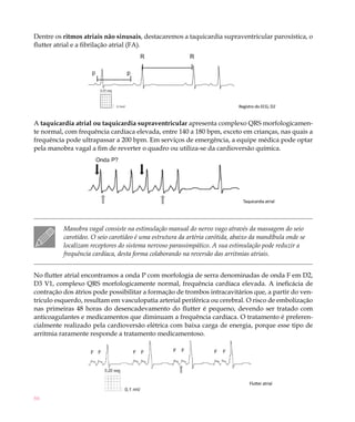 86
Dentre os ritmos atriais não sinusais, destacaremos a taquicardia supraventricular paroxística, o
flutter atrial e a fibrilação atrial (FA).
A taquicardia atrial ou taquicardia supraventricular apresenta complexo QRS morfologicamen-
te normal, com frequência cardíaca elevada, entre 140 a 180 bpm, exceto em crianças, nas quais a
frequência pode ultrapassar a 200 bpm. Em serviços de emergência, a equipe médica pode optar
pela manobra vagal a fim de reverter o quadro ou utiliza-se da cardioversão química.
Manobra vagal consiste na estimulação manual do nervo vago através da massagem do seio
carotídeo. O seio carotídeo é uma estrutura da artéria carótida, abaixo da mandíbula onde se
localizam receptores do sistema nervoso parassimpático. A sua estimulação pode reduzir a
frequência cardíaca, desta forma colaborando na reversão das arritmias atriais.
No flutter atrial encontramos a onda P com morfologia de serra denominadas de onda F em D2,
D3 V1, complexo QRS morfologicamente normal, frequência cardíaca elevada. A ineficácia de
contração dos átrios pode possibilitar a formação de trombos intracavitários que, a partir do ven-
trículo esquerdo, resultam em vasculopatia arterial periférica ou cerebral. O risco de embolização
nas primeiras 48 horas do desencadevamento do flutter é pequeno, devendo ser tratado com
anticoagulantes e medicamentos que diminuam a frequência cardíaca. O tratamento é preferen-
cialmente realizado pela cardioversão elétrica com baixa carga de energia, porque esse tipo de
arritmia raramente responde a tratamento medicamentoso.
Taquicardia atrial
Registro do ECG; D2
Flutter atrial
 