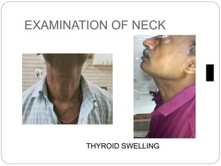 EXAMINATION OF NECK
THYROID SWELLING
 