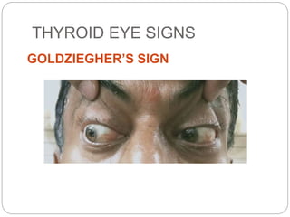 THYROID EYE SIGNS
GOLDZIEGHER’S SIGN
 