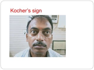 Kocher’s sign
 