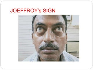 JOEFFROY’s SIGN
 