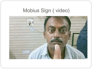 Mobius Sign ( video)
 