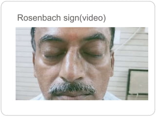 Rosenbach sign(video)
 