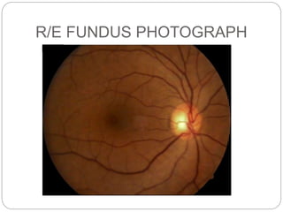 R/E FUNDUS PHOTOGRAPH
 