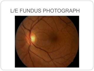 L/E FUNDUS PHOTOGRAPH
 