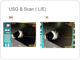 USG B Scan ( L/E)
MR IR
 