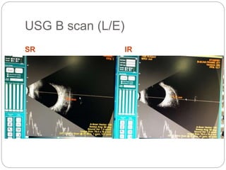 USG B scan (L/E)
SR IR
 