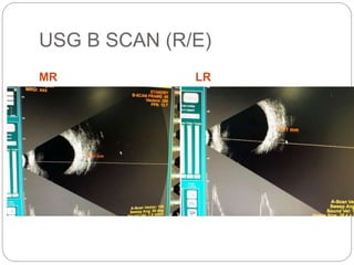 USG B SCAN (R/E)
MR LR
 