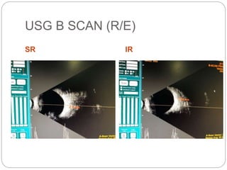 USG B SCAN (R/E)
SR IR
 