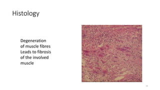 Histology
Degeneration
of muscle fibres
Leads to fibrosis
of the involved
muscle
10
 