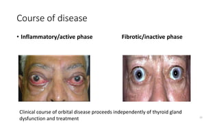 Course of disease
• Inflammatory/active phase Fibrotic/inactive phase
Clinical course of orbital disease proceeds independently of thyroid gland
dysfunction and treatment 12
 