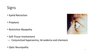 Signs
• Eyelid Retraction
• Proptosis
• Restrictive Myopathy
• Soft Tissue Involvement
--- Conjunctival hyperaemia, lid oedema and chemosis
• Optic Neuropathy
14
 