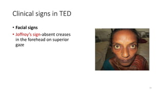 Clinical signs in TED
• Facial signs
• Joffroy’s sign-absent creases
in the forehead on superior
gaze
15
 
