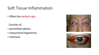 Soft Tissue Inflammation
• Often the earliest sign.
Consists of
• periorbital edema
• conjunctival hyperemia
• chemosis
17
 