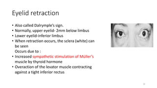 Eyelid retraction
• Also called Dalrymple’s sign.
• Normally, upper eyelid- 2mm below limbus
• Lower eyelid-inferior limbus
• When retraction occurs, the sclera (white) can
be seen
Occurs due to :
• Increased sympathetic stimulation of Müller’s
muscle by thyroid hormone
• Overaction of the levator muscle contracting
against a tight inferior rectus
18
 