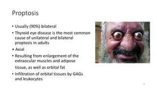 Proptosis
• Usually (90%) bilateral
• Thyroid eye disease is the most common
cause of unilateral and bilateral
proptosis in adults
• Axial
• Resulting from enlargement of the
extraocular muscles and adipose
tissue, as well as orbital fat
• Infiltration of orbital tissues by GAGs
and leukocytes
19
 