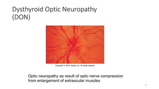 Dysthyroid Optic Neuropathy
(DON)
Optic neuropathy as result of optic nerve compression
from enlargement of extraocular muscles
22
 