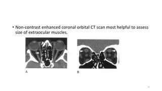 • Non-contrast enhanced coronal orbital CT scan most helpful to assess
size of extraocular muscles.
32
 