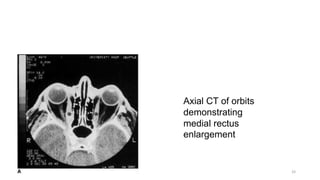 Axial CT of orbits
demonstrating
medial rectus
enlargement
33
 