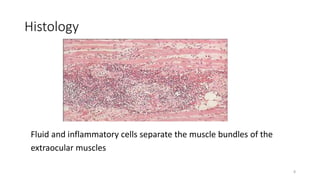 Histology
Fluid and inflammatory cells separate the muscle bundles of the
extraocular muscles
8
 